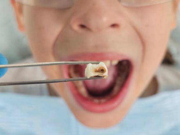 Best Urgent Tooth Repair  in Swede Heaven, WA